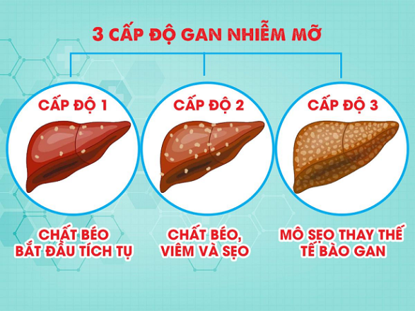 Gan nhiễm mỡ qua ba giai đoạn